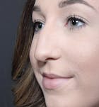 Rhinoplasty Before & After Gallery - Patient 14089540 - Image 1