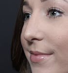 Rhinoplasty Before & After Gallery - Patient 14089540 - Image 2