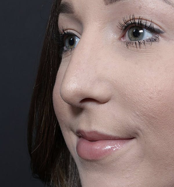Rhinoplasty Before & After Gallery - Patient 14089540 - Image 2