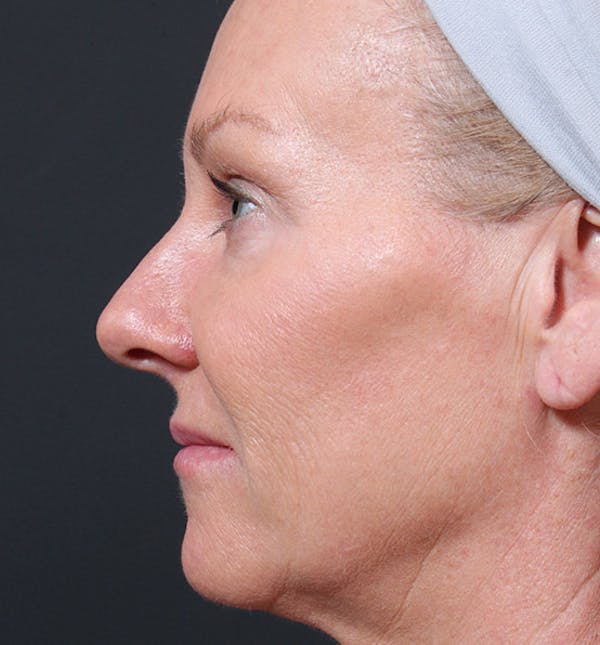 Facelift Before & After Gallery - Patient 14089539 - Image 5