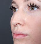 Non-Surgical Rhinoplasty Before & After Gallery - Patient 14089543 - Image 1