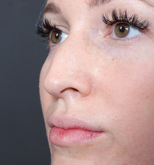 Non-Surgical Rhinoplasty Before & After Gallery - Patient 14089543 - Image 1