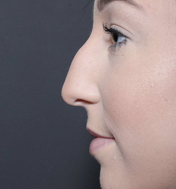 Rhinoplasty Before & After Gallery - Patient 14089540 - Image 5