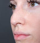 Non-Surgical Rhinoplasty Before & After Gallery - Patient 14089543 - Image 2