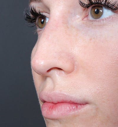 Non-Surgical Rhinoplasty Before & After Gallery - Patient 14089543 - Image 2
