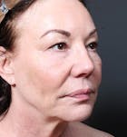 Neck Lift Before & After Gallery - Patient 14089541 - Image 1
