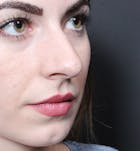 Rhinoplasty Before & After Gallery - Patient 14089547 - Image 1