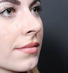 Rhinoplasty Before & After Gallery - Patient 14089547 - Image 2