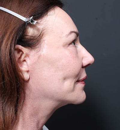 Neck Lift Before & After Gallery - Patient 14089541 - Image 6