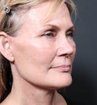 Neck Lift Before & After Gallery - Patient 14089546 - Image 2