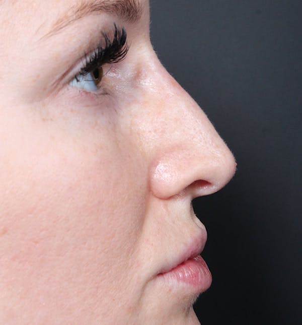 Non-Surgical Rhinoplasty Before & After Gallery - Patient 14089543 - Image 10