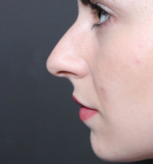 Rhinoplasty Before & After Gallery - Patient 14089547 - Image 7