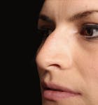 Non-Surgical Rhinoplasty Before & After Gallery - Patient 14089549 - Image 1