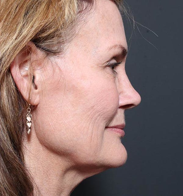 Neck Lift Before & After Gallery - Patient 14089546 - Image 5