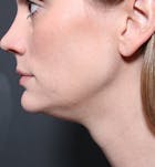 Neck Liposuction Before & After Gallery - Patient 14089548 - Image 1