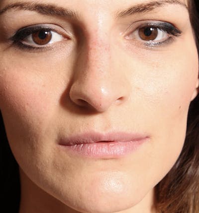 Non-Surgical Rhinoplasty Before & After Gallery - Patient 14089549 - Image 4