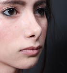 Rhinoplasty Before & After Gallery - Patient 14089550 - Image 1