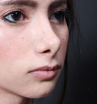 Rhinoplasty Before & After Gallery - Patient 14089550 - Image 1