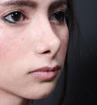 Rhinoplasty Before & After Gallery - Patient 14089550 - Image 1