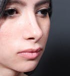 Rhinoplasty Before & After Gallery - Patient 14089550 - Image 2