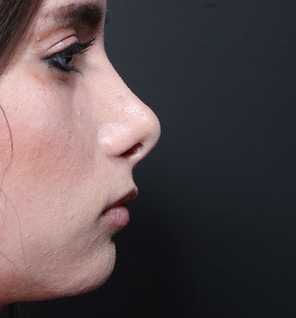 Rhinoplasty Before & After Gallery - Patient 14089550 - Image 5