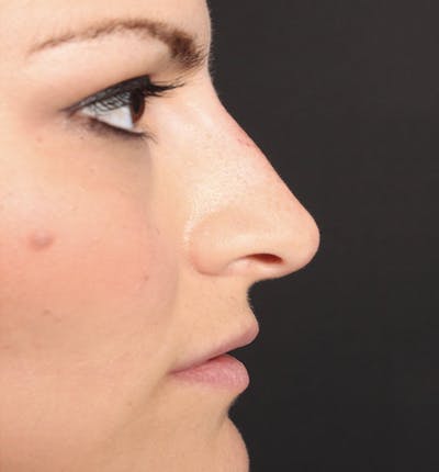 Non-Surgical Rhinoplasty Before & After Gallery - Patient 14089549 - Image 10