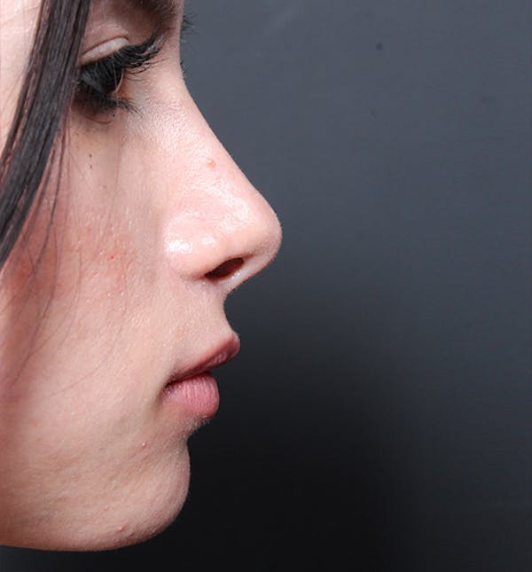 Rhinoplasty Before & After Gallery - Patient 14089550 - Image 6