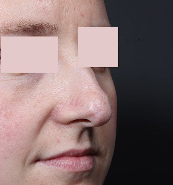 Rhinoplasty Before & After Gallery - Patient 14089554 - Image 1