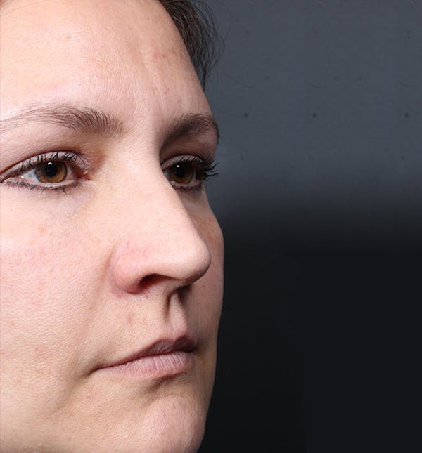 Non-Surgical Rhinoplasty Before & After Gallery - Patient 14089552 - Image 1
