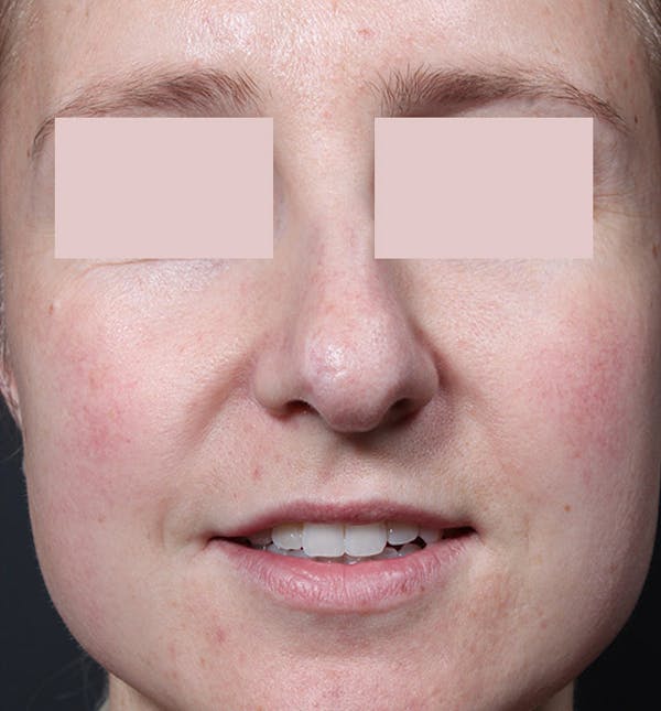 Rhinoplasty Before & After Gallery - Patient 14089554 - Image 3