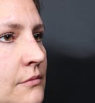 Non-Surgical Rhinoplasty Before & After Gallery - Patient 14089552 - Image 2