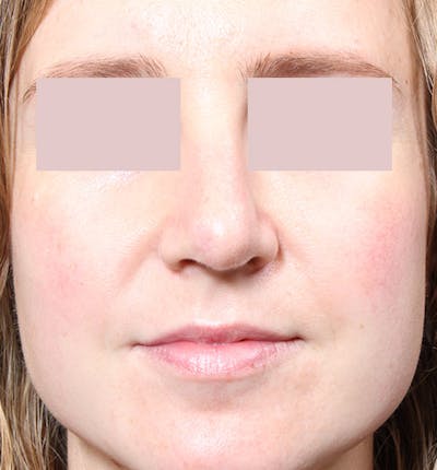 Rhinoplasty Before & After Gallery - Patient 14089554 - Image 4