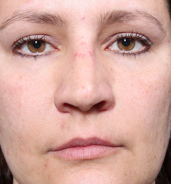 Non-Surgical Rhinoplasty Before & After Gallery - Patient 14089552 - Image 4