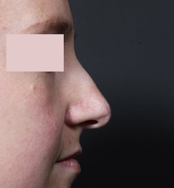 Rhinoplasty Before & After Gallery - Patient 14089554 - Image 5