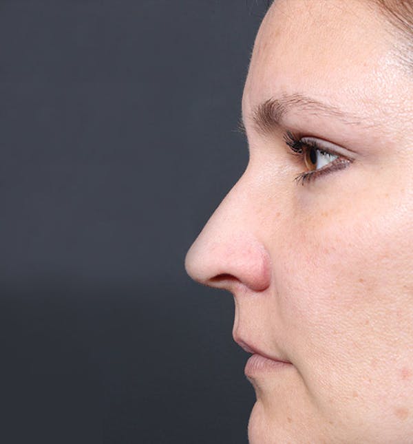 Non-Surgical Rhinoplasty Before & After Gallery - Patient 14089552 - Image 5