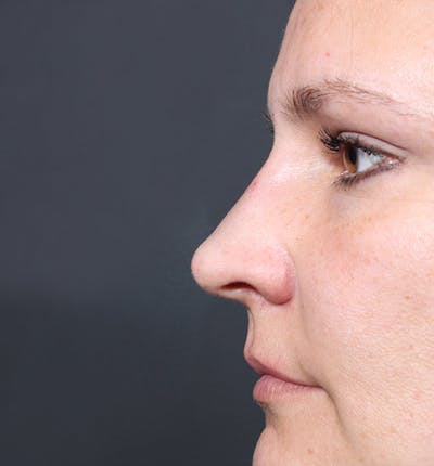 Non-Surgical Rhinoplasty Before & After Gallery - Patient 14089552 - Image 6