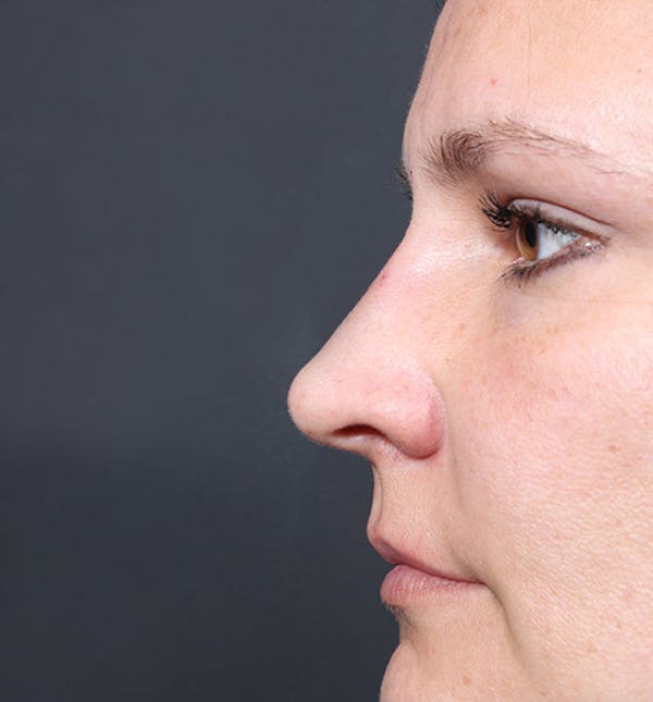 Non-Surgical Rhinoplasty Before & After Gallery - Patient 14089552 - Image 6