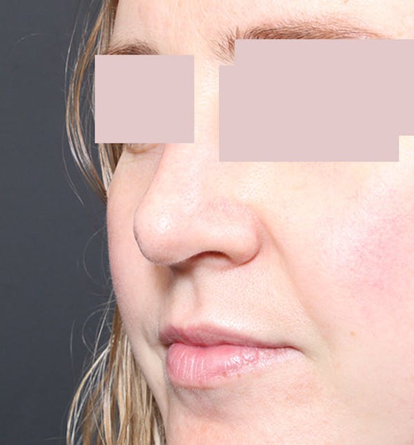 Rhinoplasty Before & After Gallery - Patient 14089554 - Image 8