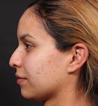 Non-Surgical Rhinoplasty Before & After Gallery - Patient 14089553 - Image 1