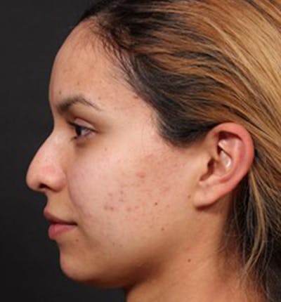 Non-Surgical Rhinoplasty Before & After Gallery - Patient 14089553 - Image 1