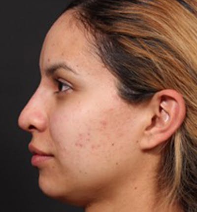 Non-Surgical Rhinoplasty Before & After Gallery - Patient 14089553 - Image 2