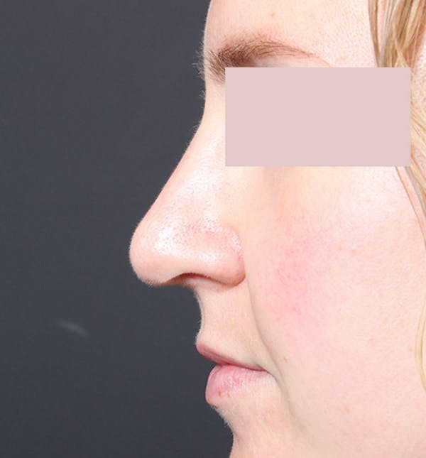 Rhinoplasty Before & After Gallery - Patient 14089554 - Image 10