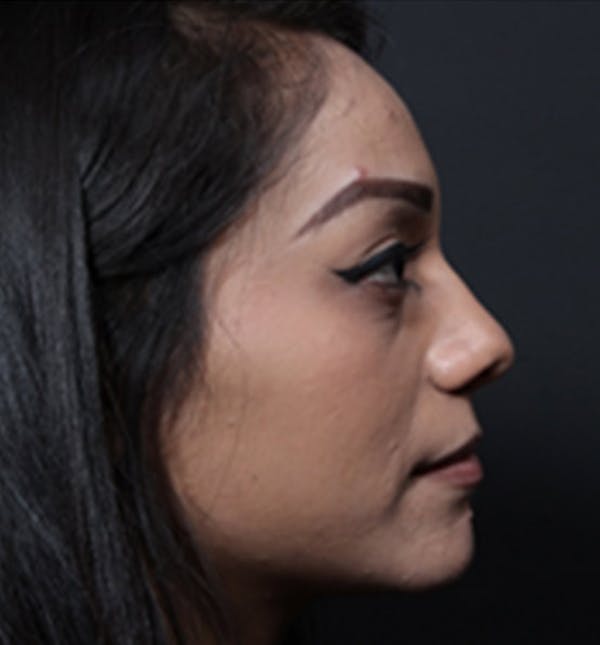 Non-Surgical Rhinoplasty Gallery - Patient 14089555 - Image 1