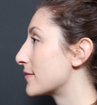 Non-Surgical Rhinoplasty Before & After Gallery - Patient 14089556 - Image 2