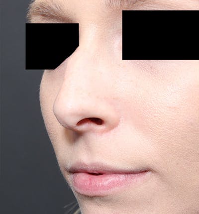 Rhinoplasty Before & After Gallery - Patient 14089562 - Image 1