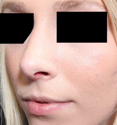 Rhinoplasty Before & After Gallery - Patient 14089562 - Image 2