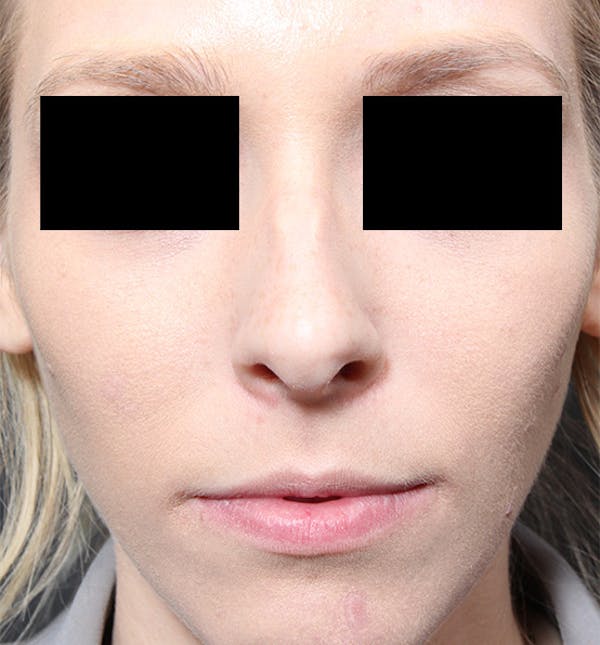 Rhinoplasty Before & After Gallery - Patient 14089562 - Image 3