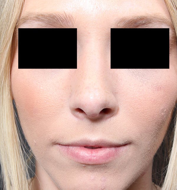 Rhinoplasty Before & After Gallery - Patient 14089562 - Image 4