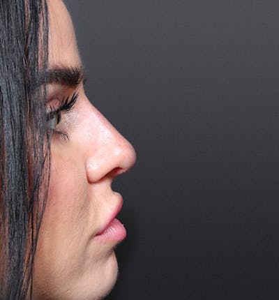 Non-Surgical Rhinoplasty Before & After Gallery - Patient 14089560 - Image 8