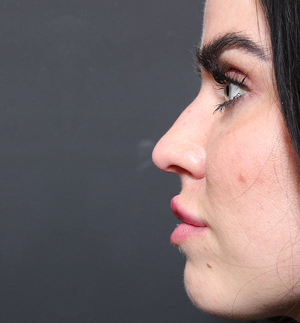Non-Surgical Rhinoplasty Before & After Gallery - Patient 14089560 - Image 9